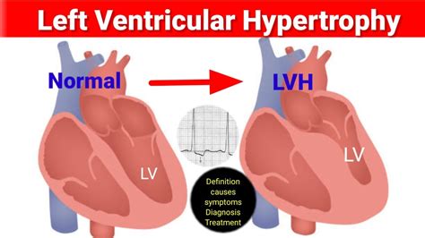 asymmetric lv hypertrophy|left ventricular hypertrophy life expectancy.